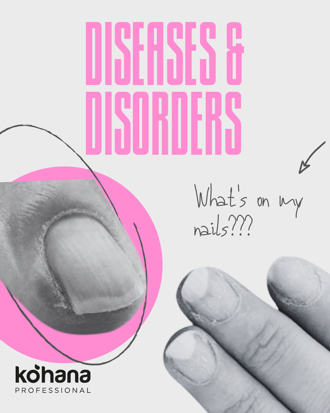 Nail Diseases & Disorders: What causes them and how to spot them