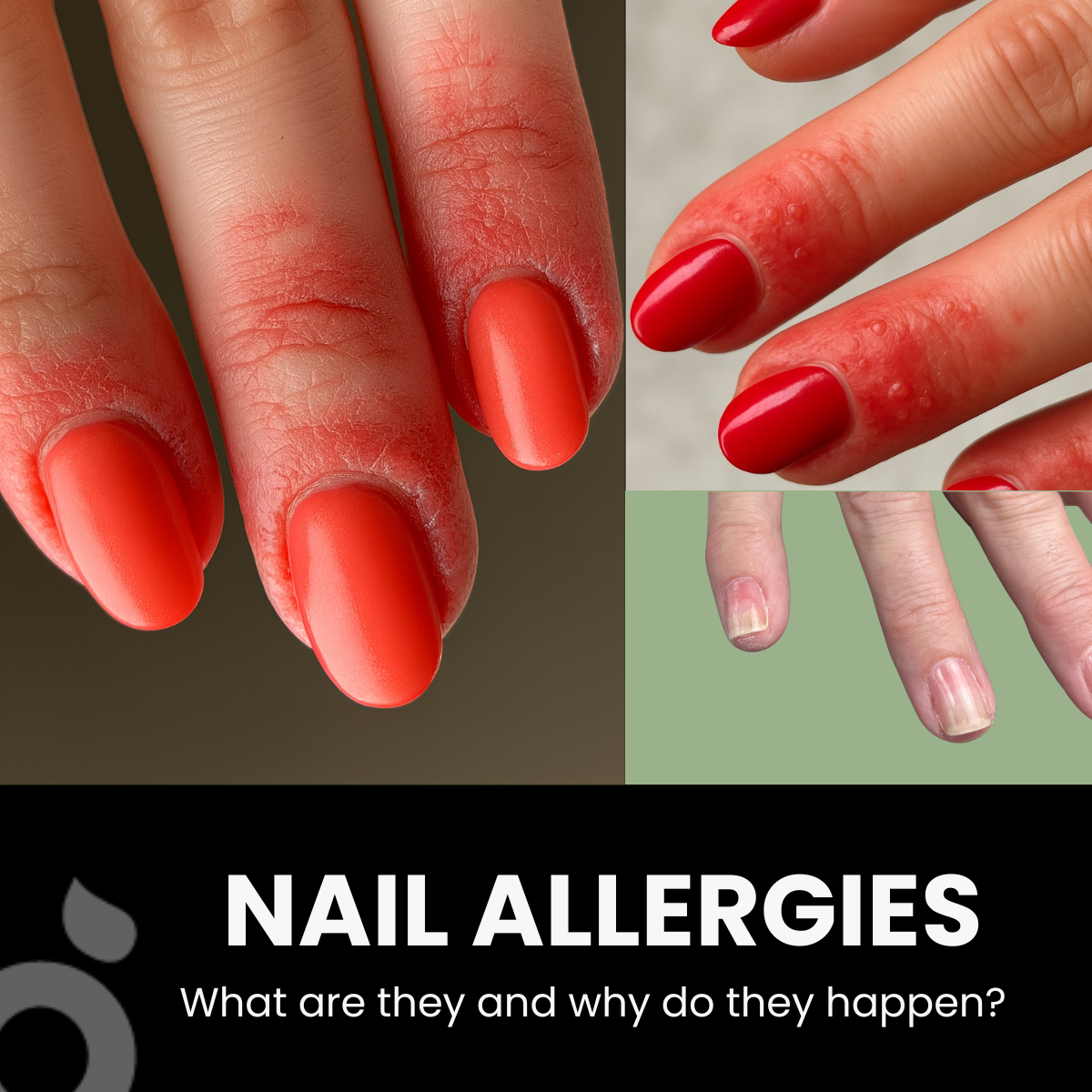 NAIL ALLERGIES - What are they? Why do they happen?